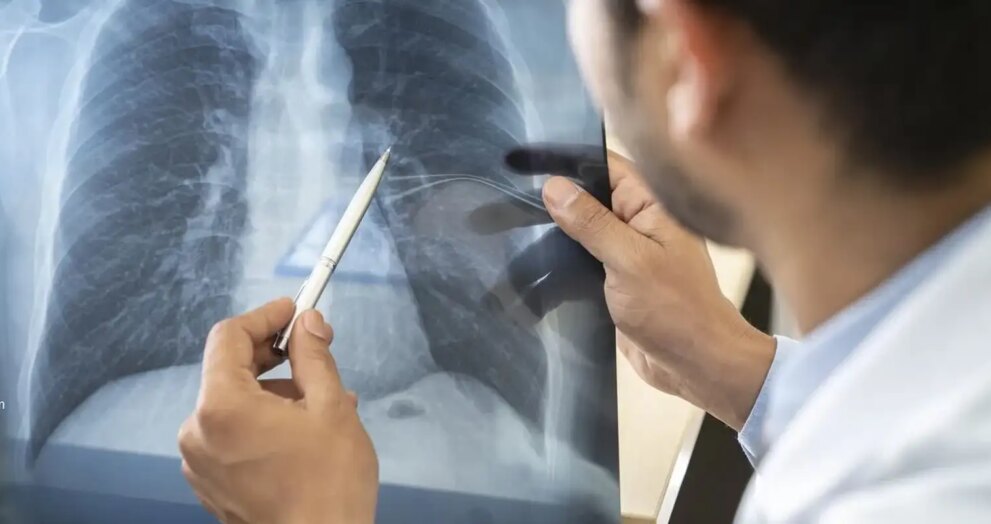 cancer-de-pulmao:-pesquisa-aponta-frequencia-de-mutacao-do-gene-egfr
