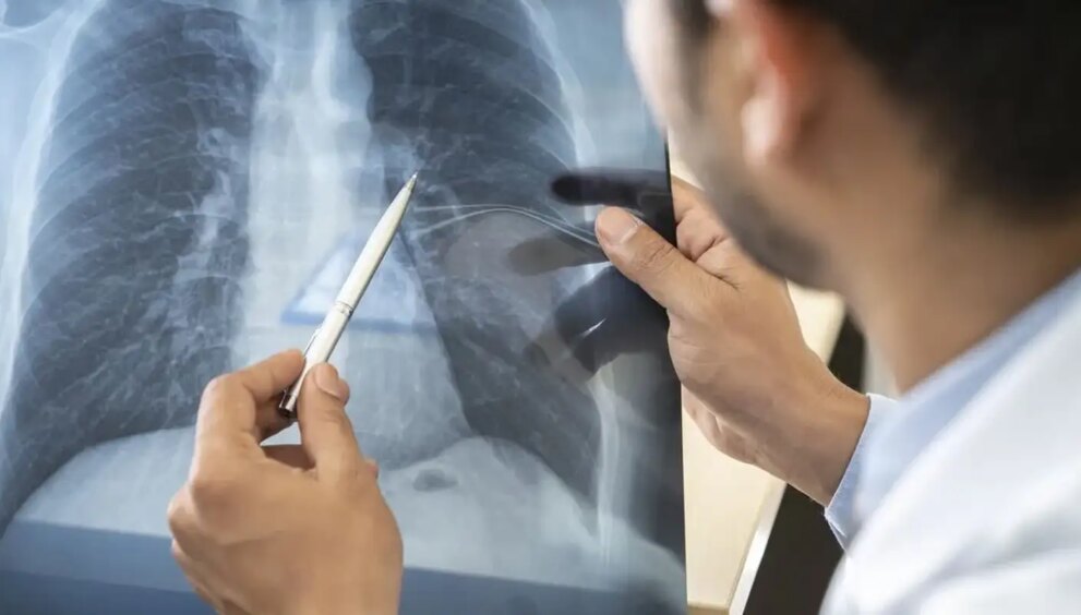 cancer-de-pulmao:-pesquisa-aponta-frequencia-de-mutacao-do-gene-egfr