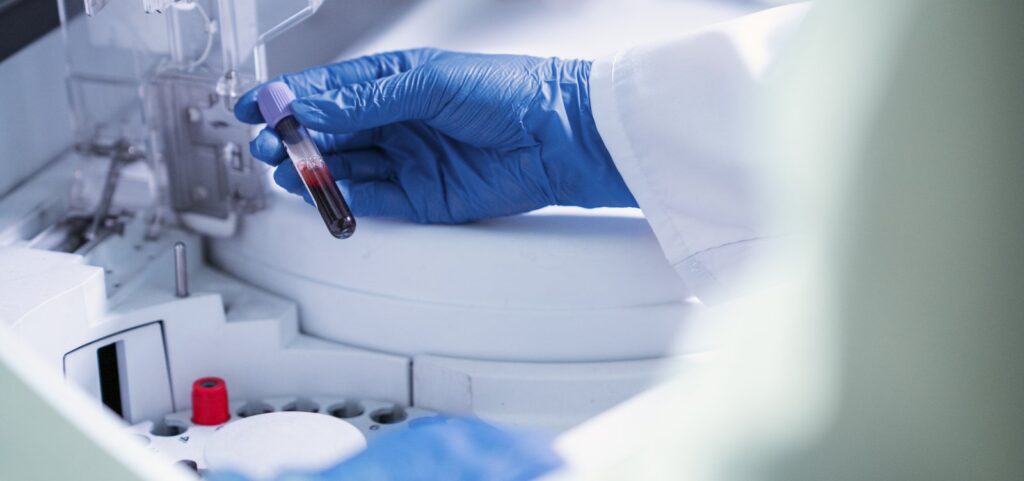 exame-de-sangue-para-detectar-alzheimer-chega-ao-brasil