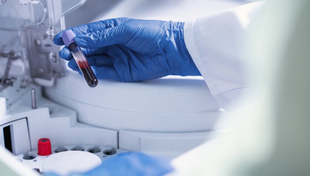 exame-de-sangue-para-detectar-alzheimer-chega-ao-brasil
