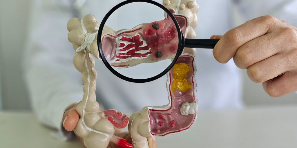 muito-frequente,-cancer-de-intestino-pode-nao-apresentar-sintomas