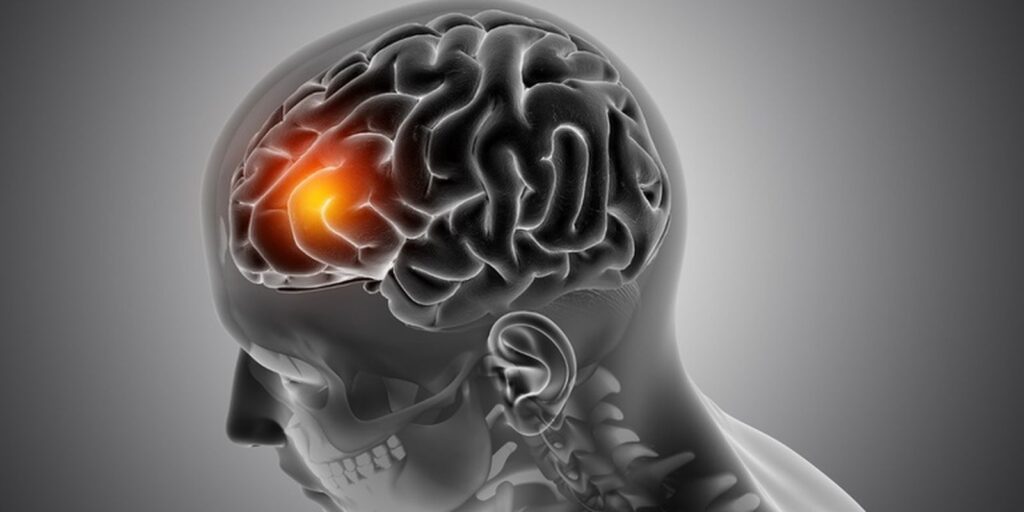 avc:-neurologista-explica-como-identificar-os-primeiros-sinais