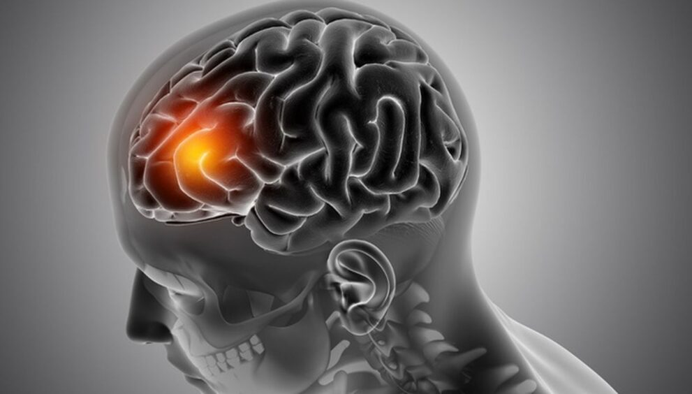 avc:-neurologista-explica-como-identificar-os-primeiros-sinais